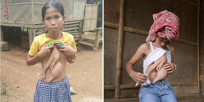 14 Yaşındaki Taylandlı Veronica, Göğsünde Büyüyen Parazit İkizinin Alınması İçin Ameliyata Hazırlanıyor!