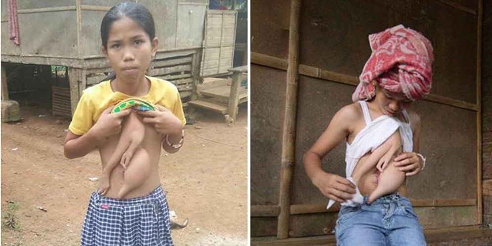 14 Yaşındaki Taylandlı Veronica, Göğsünde Büyüyen Parazit İkizinin Alınması İçin Ameliyata Hazırlanıyor!