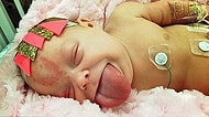 Sahip Olduğu Sendrom Yüzünden Normalden İki Kat Büyük Bir Dille Doğan Bebek