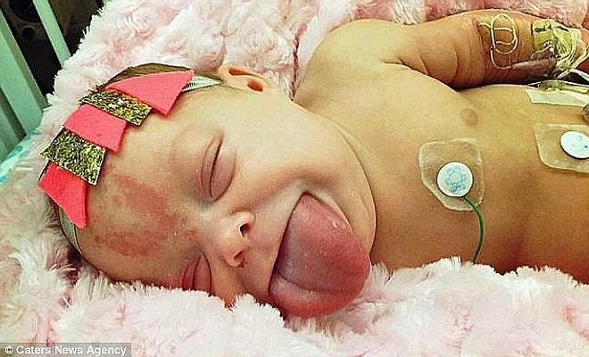 Sahip Olduğu Sendrom Yüzünden Normalden İki Kat Büyük Bir Dille Doğan Bebek