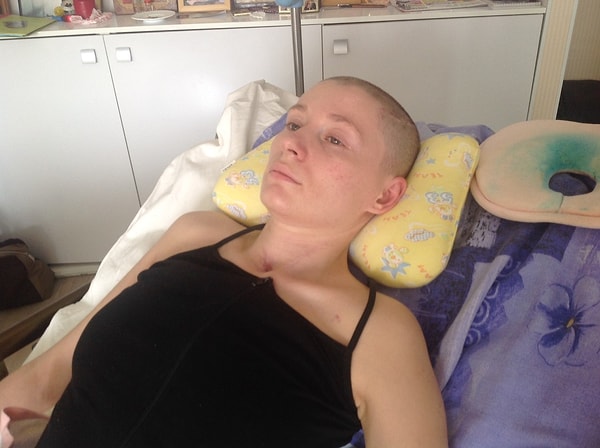 2. А вот Екатерина уже после аварии и операции. Катя провела в коме полмесяца, у нее переломан шейный позвонок, и она не может ходить. Но храбрая девушка не намерена сдаваться и изо всех сил пытается подняться на ноги.