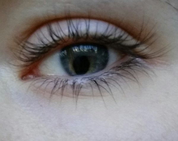 1. У этого мужчины дефект под названием колобома, который проявляется в отсутствии части глазной оболочки.