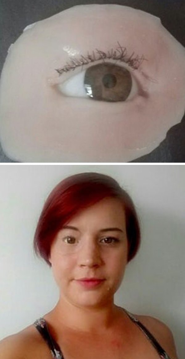 4. Вот так выглядит глазной протез этой девушки: