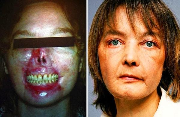 19. Kendi köpeğinin saldırısına uğrayan ve yüzünün bir kısmı parçalanan Isabelle Dinoire.