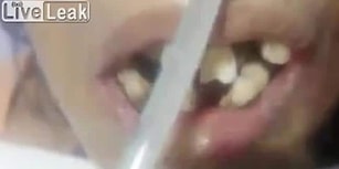 Dişçi Şoka Uğradı! Ağzının İçinde Kurtlar Yaşayan Hindistanlı Hasta