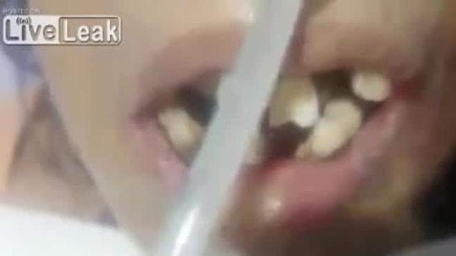 Dişçi Şoka Uğradı! Ağzının İçinde Kurtlar Yaşayan Hindistanlı Hasta