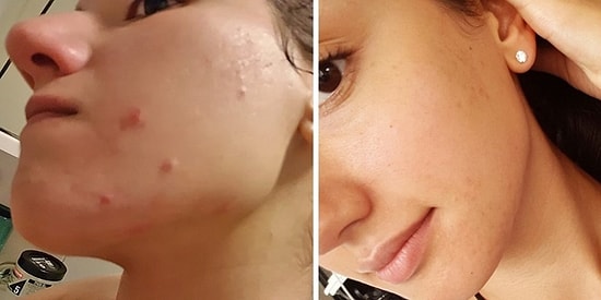 Başlangıçta Her Şey Çok İyiydi! 4 Yıllık Vegan Diyetini Sağlığına Tekrar Kavuşmak İçin Sonlandıran Blog Yazarı