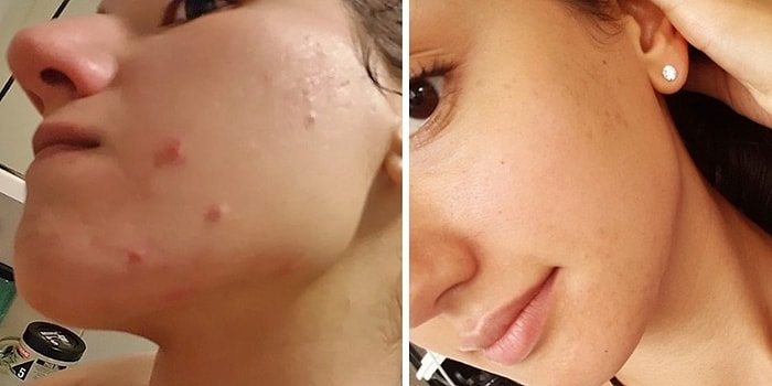 Başlangıçta Her Şey Çok İyiydi! 4 Yıllık Vegan Diyetini Sağlığına Tekrar Kavuşmak İçin Sonlandıran Blog Yazarı