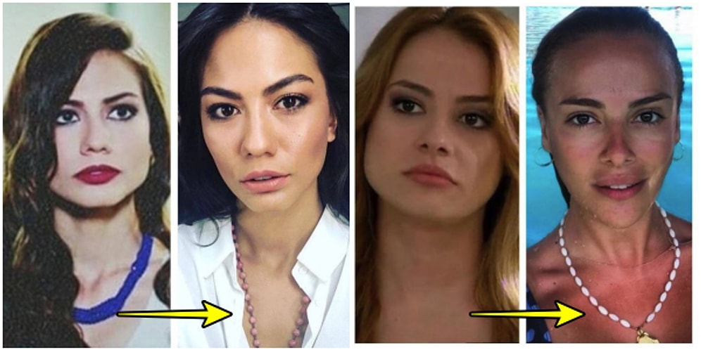 Estetiğin Gücü... Parası Neyse Verip Kendine Yeni Bir Çene Alan 17 Ünlünün Hepinizi Şok Edecek Değişimi