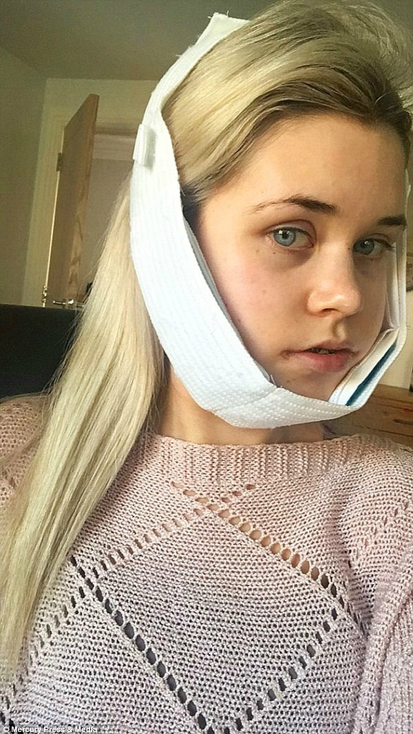 В течение шести недель девушка страдала из-за опухоли и кровоподтеков на лице и шее, но при этом весь дискомфорт стоил всего этого