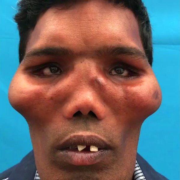 Suresh, ameliyattan önce böyle görünüyordu.