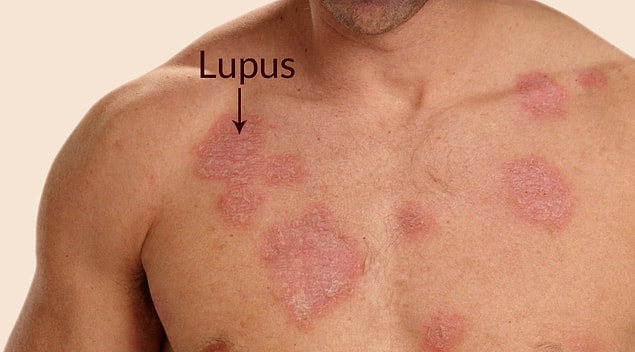 Sistemik Lupus Eritematozus (SLE) (Systemical Lupus Erythematosus) ya da Yaygın Lupus Kızarıklığı, Sistemik Lupus Eritematozus tabipler arasında Lupus olarak da tanımlanmaktadır.