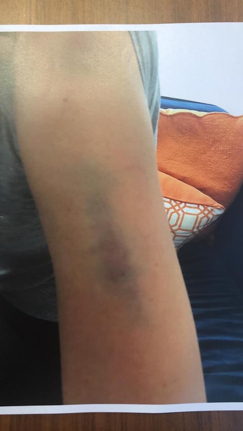 Ünlü müzisyen kollarındaki morlukları gösteren fotoğrafları da delil olarak sunmuştu.