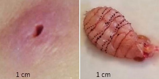 Balayından Döndükten Sonra Sürekli Kaşınan Kadının Derisinin Altından Canlı Kurtçuk Çıktı!