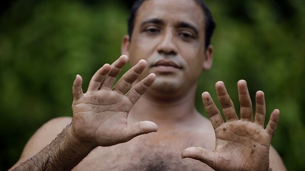 5. Как называется состояние, когда у человека на кистях или стопах более пяти пальцев?