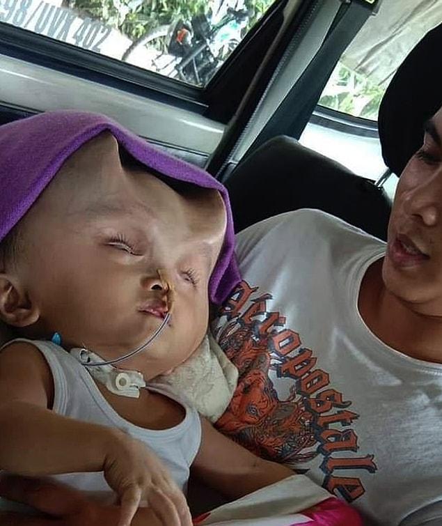 He was born in January 2017 in the Philippines and his mother quickly noticed problem in his skull.