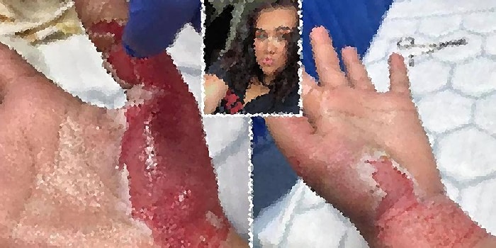Mum Işığının Yanında Aseton Kullanan Genç Kadının Ellerinde Üçüncü Dereceden Yanıklar Oluştu!