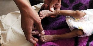 Yemen'de Yaşanan İnsanlık Dramına İlişkin Korkunç Rapor: '85 Bin Çocuk Açlıktan Öldü'