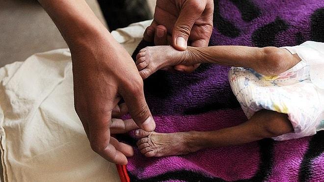 Yemen'de Yaşanan İnsanlık Dramına İlişkin Korkunç Rapor: '85 Bin Çocuk Açlıktan Öldü'