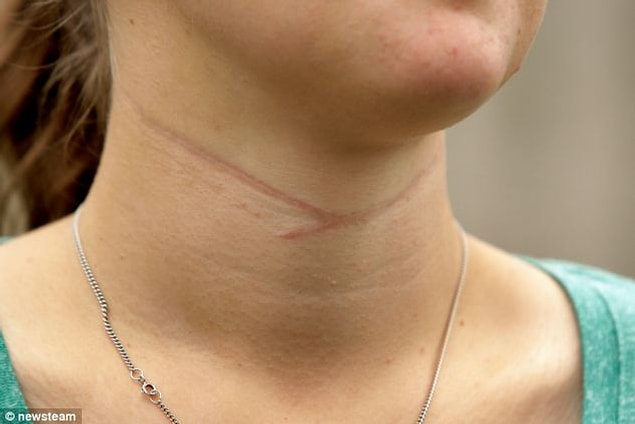 5. "Boynumda büyük bir ameliyat izi var. Birisi bu yara izi hakkında dedikodu çıkarmış ve herkese bir kavgaya karıştığımı ve kavga ettiğim kişinin boynumu kestiğini söylemiş."