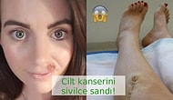 Erken Teşhis Yine Hayat Kurtardı: Yüzünde Görülen Kanser Belirtisi Yarayı Sivilce Zanneden Kadın