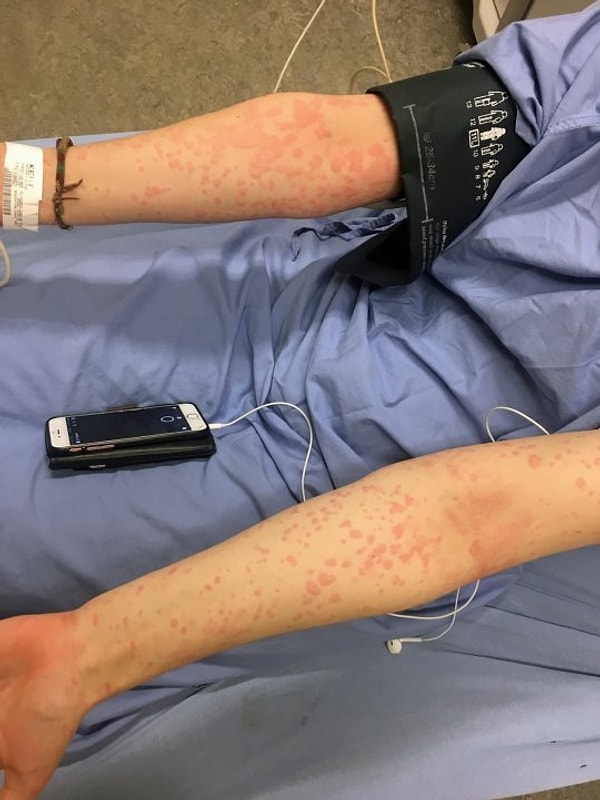 Ариана не всегда страдала холодовой крапивницей. Все началось, когда ей было 14 лет. В тот день она убирала снег перед своим домом. Тогда ее семья подумала, что у девочки аллергия на продукты, которые она съела, и отвезла ее в больницу. В результате анализов Ариана узнала, что страдает редкой формой аллергической реакции.