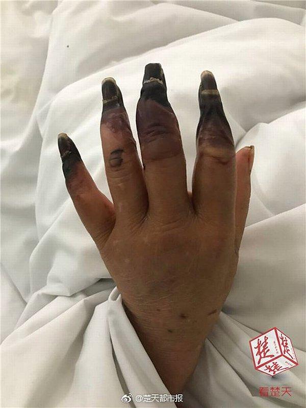 Fakat kadın daha sonra baş parmakları hariç her iki elinde de tüm parmakların kararmasıyla bir şok yaşadı ve hemen hastaneye gitti.