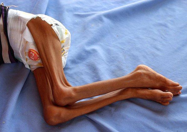 16. Yemen'de iç savaşın yarattığı sorunlar yüzünden, zor durumdaki ülkenin daha da kötüye gidişi ve açlıktan ölmek üzere bir çocuk
