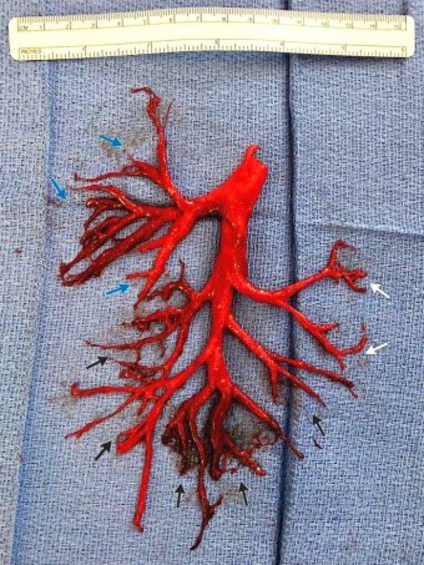 Kalp hastası bir kişinin Kaliforniya’da gittiği hastanede akciğerinin bir kısmını öksürerek vücudundan attığı iddiası doğru değil. Hastanın vücudundan çıkan ve fotoğrafta görünen parça bronş ağacının şeklini almış bütün halinde bir kan pıhtısı.