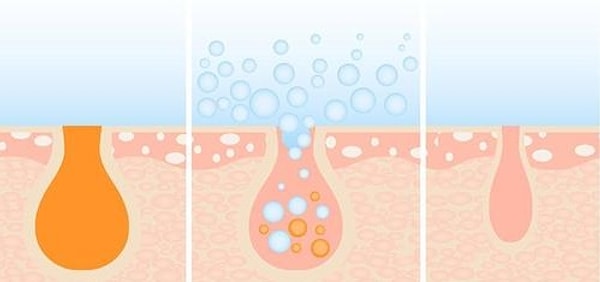 Причина появления расширенных пор