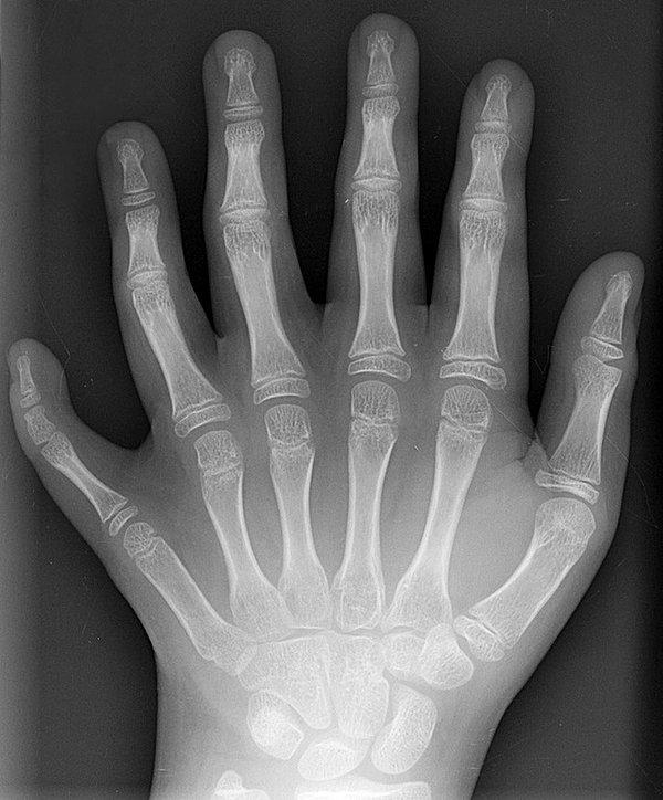1. Polidaktili bir elin röntgeni:
