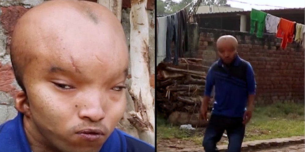 Acımasızca "Uzaylı" Lakabı Takılan Genç Adam Ameliyat Olup Aile Kurabilmeyi Bekliyor!