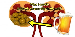 Bende Olmaz Demeyin! Böbrek Taşı ile İlgili En Merak Edilen Sorular ve Cevapları