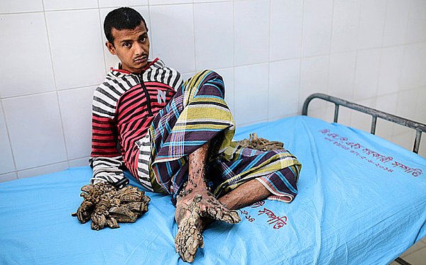 Bu hastalığın tedavisi hala bulunamadı. Fakat doktorlar, Bajandar'ı tekrar hastanede görmeden önce hastalığı yendiklerini düşünmüşlerdi.