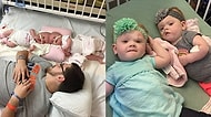 Helal Olsun Size Minikler! Ezber Bozan Bir Ameliyatla Ayrılıp Hayatta Kalabilen Yapışık İkizler