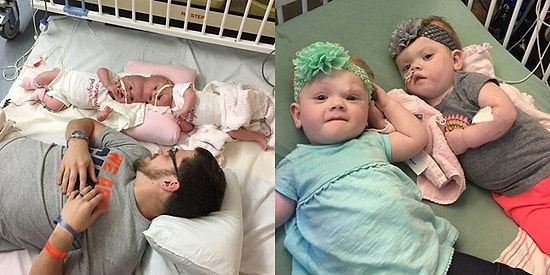 Helal Olsun Size Minikler! Ezber Bozan Bir Ameliyatla Ayrılıp Hayatta Kalabilen Yapışık İkizler