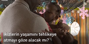 Yapışık İkiz Babasının Zor Seçimi: 'Bir Çocuğumu Hayatta Tutmak İçin Diğerinin Ölümüne Razı Olamam'