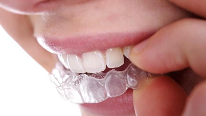 Çapraşık ve Yamuk Diş Tedavisinde Mutlaka Bilmeniz Gereken Alternatif Tedavi Yöntemi: Şeffaf Plak Tedavisi