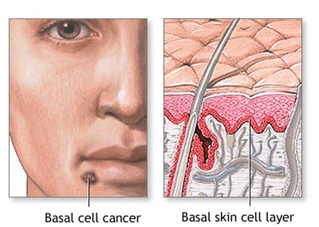 3. Bazal hücreli karsinom belirti ve semptomları nelerdir?