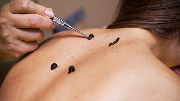 7. Какая терапия - это лечение пиявками?