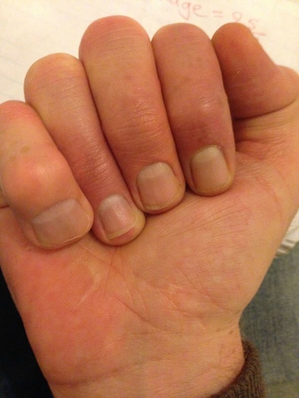 7. Когда мизинец стал большим пальцем