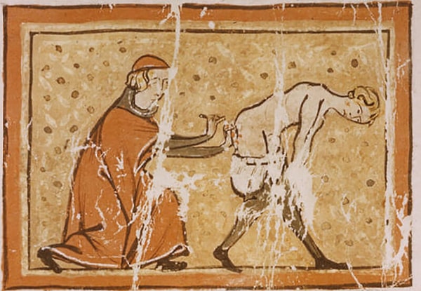 1. Прижигание геморроя раскаленным железом