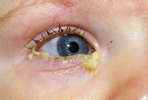 7. Göz yaşı kanalı henüz açılmamış bebeklerde çapaklanma görülebilir.