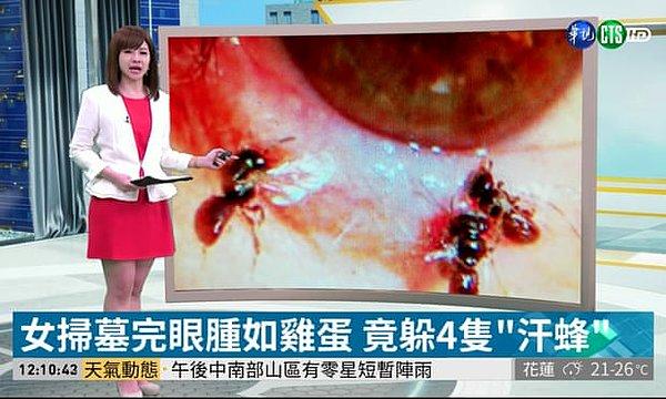 Tayvan'daki Fooyin Üniversite Hastanesi'ndeki doktorlar bu vakanın dünyada ilk olduğunu ve dört arının başarılı bir şekilde gözünden çıkarıldığını belirttiler.