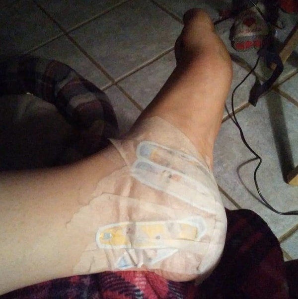 11. Замороженные пластыри спасают эту молодую маму от зуда при укусах комаров.