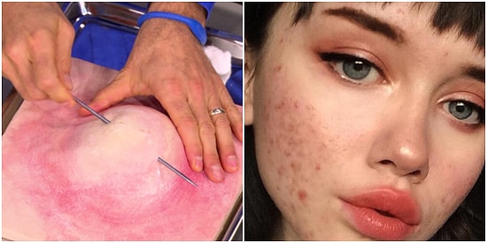 Sürekli Dokunmadan Duramasa da Pürüzsüz Bir Cilt İsteyenler İçin Sivilce En Doğru Şekilde Nasıl Sıkılır Anlatıyoruz!