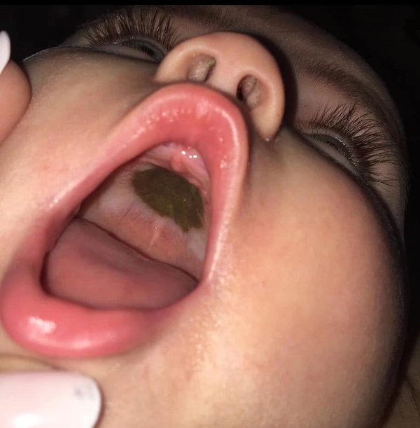 Bebeğin damağındaki görüntü