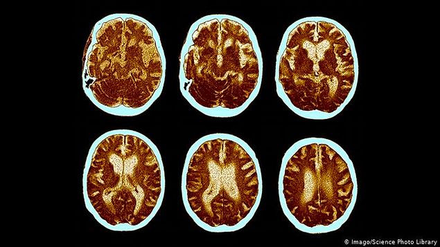 Norveç’te bulunan Bergen Üniversitesi’nden araştırmacıların yaptığı yeni bir çalışma sayesinde, diş eti hastalığı ile Alzheimer arasında doğrudan bir bağlantı olduğu tespit edildi.