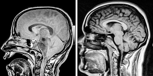 1. Komadaki (sol) ve sağlıklı (sağ) kişilerin beyinleri: