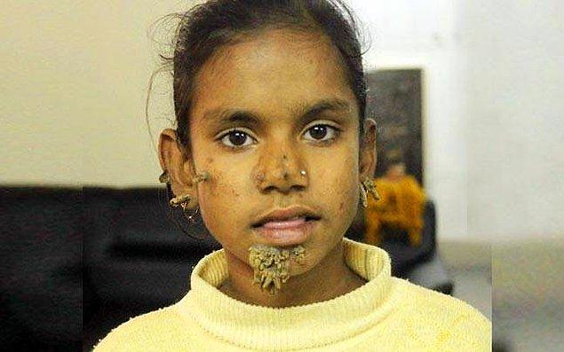 Aynı hastane, 2017'de aynı durumdan muzdarip olan genç bir Bangladeşli kızı da tedavi etmişti.